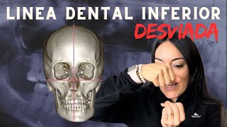 ¿Sonrisa Desviada  Las Causas de la linea media inferior desviada [upl. by Enivid]