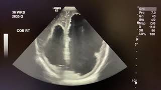 Ultrasound cases Neurosonography  Hydrocephalus  abnormal neonatal brain study encephalogram [upl. by Sacha14]