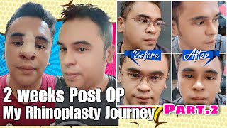 2 Weeks Post OP My Rhinoplasty Journey Part 2 by Doc Ferdinand Lacson Kosmed [upl. by Berlauda]