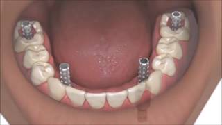 AllOn4 Dental Implants Coventry Best Same Day Full Whole Mouth Teeth Implants At Verum Dentists [upl. by Neenaj721]