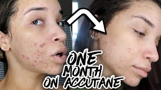 First Month on Accutane  ITS WORKING  Acne Update 4 [upl. by Collum516]