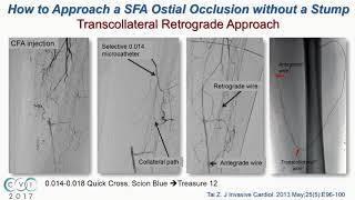 Case Discussion How to Approach an SFA Ostial Occlusion Without a Stump  Subhash Banerjee MD [upl. by Mohkos642]