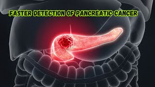 Faster detection of pancreatic cancer [upl. by Zenobia]