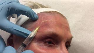 Face Sclerotherapy Video [upl. by Sherill]