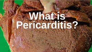 What is Pericarditis  Pathology mini tutorial [upl. by Eldin870]