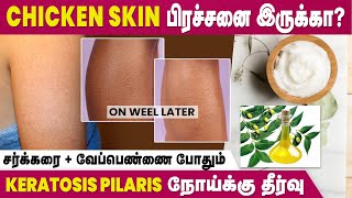 Affected By Keratosis Pilaris Disease  Home Remedies To Cure Chicken Skin  IBC Mangai [upl. by Pinter]