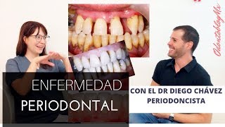 TODO SOBRE la Enfermedad Periodontal [upl. by Lleznov]