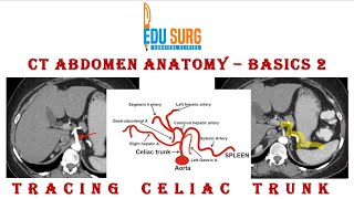 CT abdomen interpretation  celiac axis [upl. by Asp]