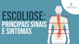 Escoliose Principais sinais e sintomas [upl. by Yessej]