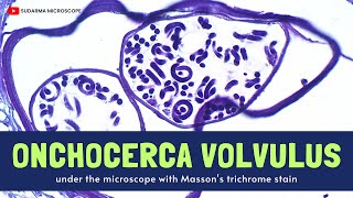 Onchocerca volvulus under the microscope with Massons trichrome stain [upl. by Millman]