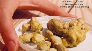 Liver Detoxify Gall Stone Cleanse Removal Of Gallstones Gallstone Attacks [upl. by Converse385]