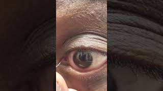 Stringy Mucus Eye Fishing Syndrome Eye Gunk Removal [upl. by Brinson]