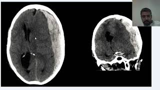 daily tip episode 1 epidural vs subdural haematomas [upl. by Vanden]