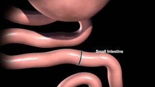 Rex Bariatrics Gastric Bypass Surgery Explained [upl. by Yrro]