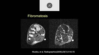 MRI of Soft Tissue Tumors  Part 2 [upl. by Tranquada]