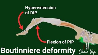 Pathophysiology of Boutonniere Deformity animated [upl. by Micky]