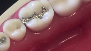 class II amalgam cavity preparation and restoration [upl. by Messing]