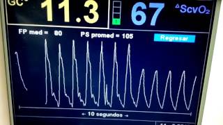 Monitoreo HEmodinámico con Swan Ganz y Vigileo en VAFO UCI las Américas [upl. by Anilahs114]