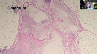 Tip85Lowgrade Appendiceal Mucinous Neoplasm LAMN [upl. by Eirehc748]