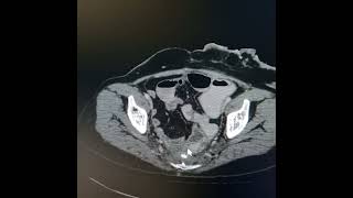 APR Radiation fibrosis adhesions causing subacute intestinal obstruction and osteoradionecrosis [upl. by Adnertal]