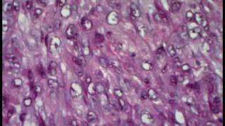 Epithelioid Sarcoma [upl. by Engelbert895]