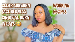 HOW TO PREVENT amp CLEAR SUNBURN FACE REDNESS amp CHEMICAL BURN Joy Ababah [upl. by Amethist495]