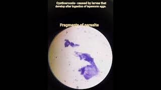 Cysticercosis Taenia solium parasitic infectionPathologyFNACCytology smear [upl. by Anaderol925]