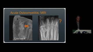 Imaging of Osteomyelitis amp Septic Arthritis  15 Minute Radiology CME [upl. by Giselle]