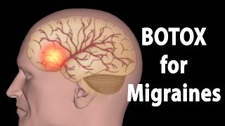 BOTOX for Migraines Animation [upl. by Eniluj]