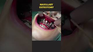 Maxillary Osteotomy shorts [upl. by Eerahs]