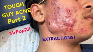 Very severe acne in a preteen patientFollow his progressExtractions of blackheads and whiteheads [upl. by Berl676]