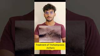 Treatment of Trichomycosis Axillaris dermatology skincaretips shorts skininfection ytshorts [upl. by Nylanna132]