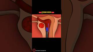 Fibroids  Sonata Treatment Animation [upl. by Acnaiv]