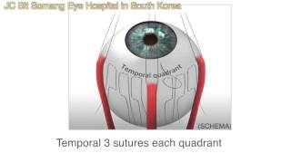 Scleral ImbricationSI for Macular Hole Macular Detachment in High Myopes [upl. by Reiners]