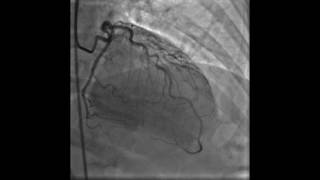 Coronary Angiogram of Myocardial Bridging [upl. by Nauq144]