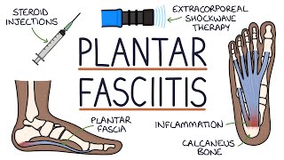 Understanding Plantar Fasciitis [upl. by Lupee332]