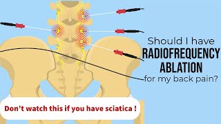 Spine surgeon When radiofrequency ablation is the right treatment for your low back pain [upl. by Loseff]