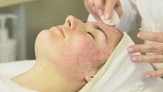 Acne Analysis And Treatment Part 1 [upl. by Wilkins]