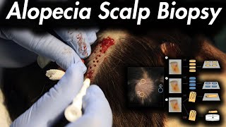 Hair Loss Consider a Scalp Biopsy [upl. by Hadeehuat]