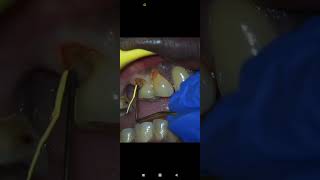 How to Pack Teflon for Gingival Retraction [upl. by Yhtrod]