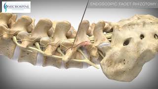 01 Endoscopic Facet Rhizotomy [upl. by Milla172]