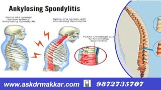 Hlab27 Ankylosing Spondolysis Permanent TreatmentAnkylosis Homeopathic  Explanations how to cure [upl. by Otirecul426]