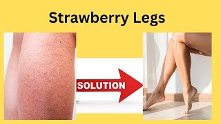 Strawberry Legs Solution  Malayalam [upl. by Lehcir247]