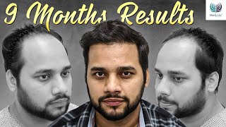 Astonishing 9 Months Results  Before and After Hair Transplant  Medlinks Delhi [upl. by Frodine]