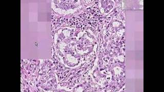 Histopathology LungAdenocarcinoma [upl. by Onailime599]