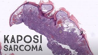 Kaposi sarcoma nodulartumor stage HHV8 HIV AIDS pathology dermpath dermatology [upl. by Possing]