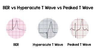 ECG interpretation T waves amp abnormality [upl. by Ahsienaj]