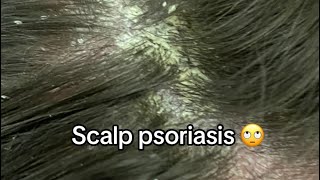 Scalp Psoriasis Removal [upl. by Malet57]