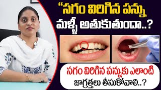 సగం విరిగిన పన్ను మళ్ళీ అతుకుతుందా  Broken Tooth Will Stick Again  Tooth Fractured [upl. by Aivirt29]