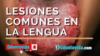 Lesiones comunes en la lengua Signos síntomas y tratamientos [upl. by Noxaj765]